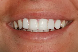 Close-up clinical view of a full smile showing white restored upper front teeth